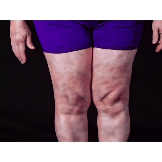 O que é Lipedema e quais são os sintomas?